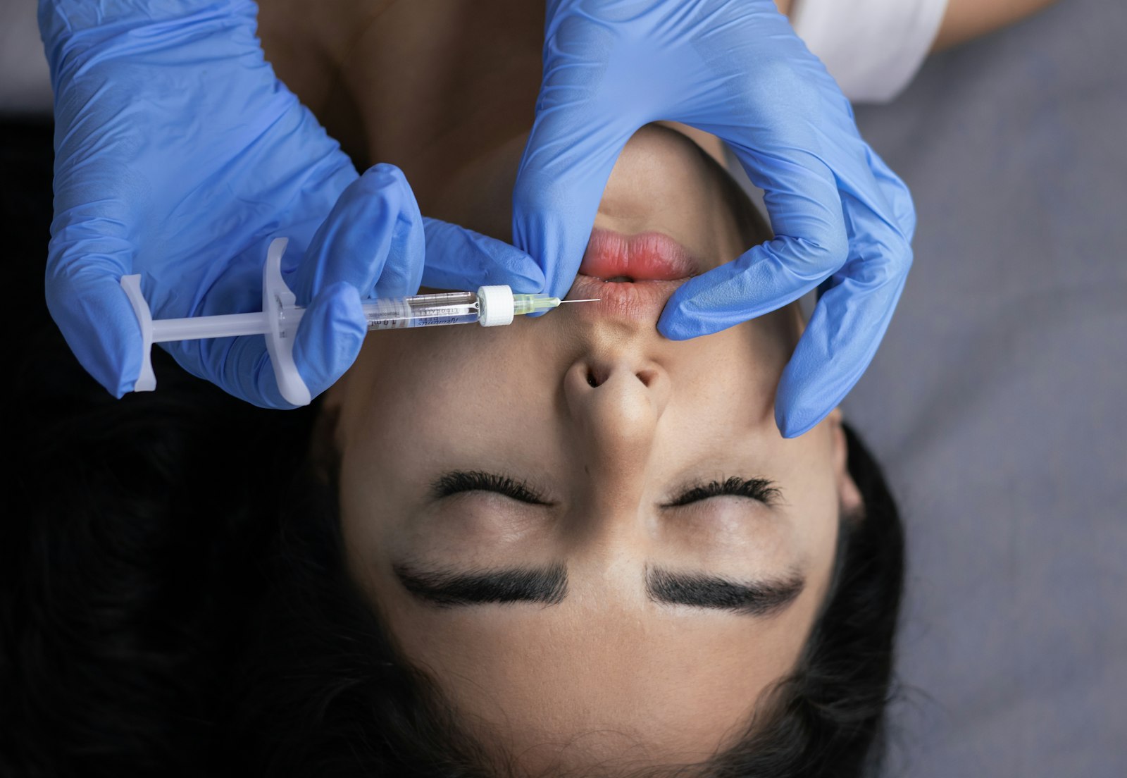 Gummy Smile Correction